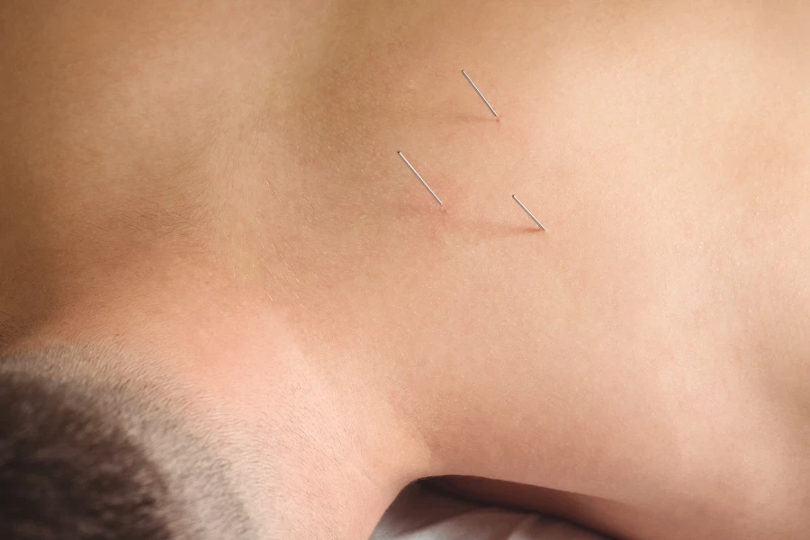 Een afbeelding over Dry Needling